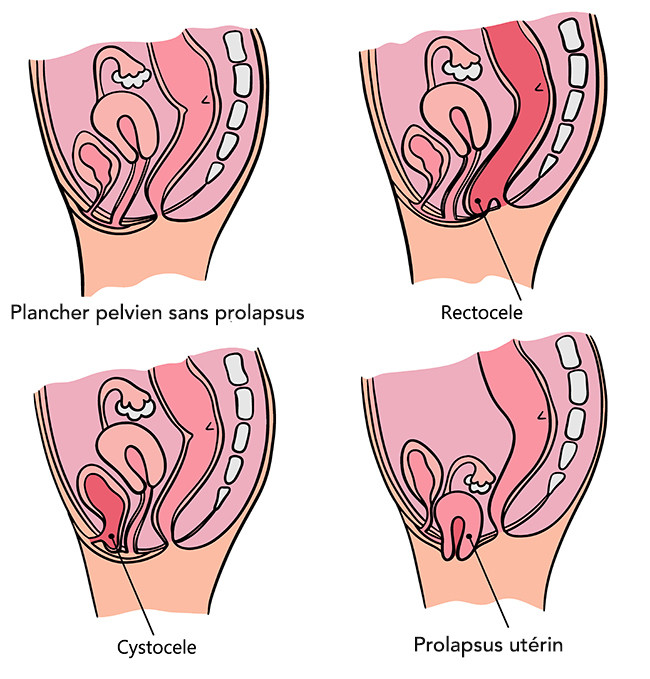  Chirurgie et traitement médical du prolapsus génital chez la femme